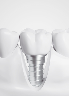 1implant
