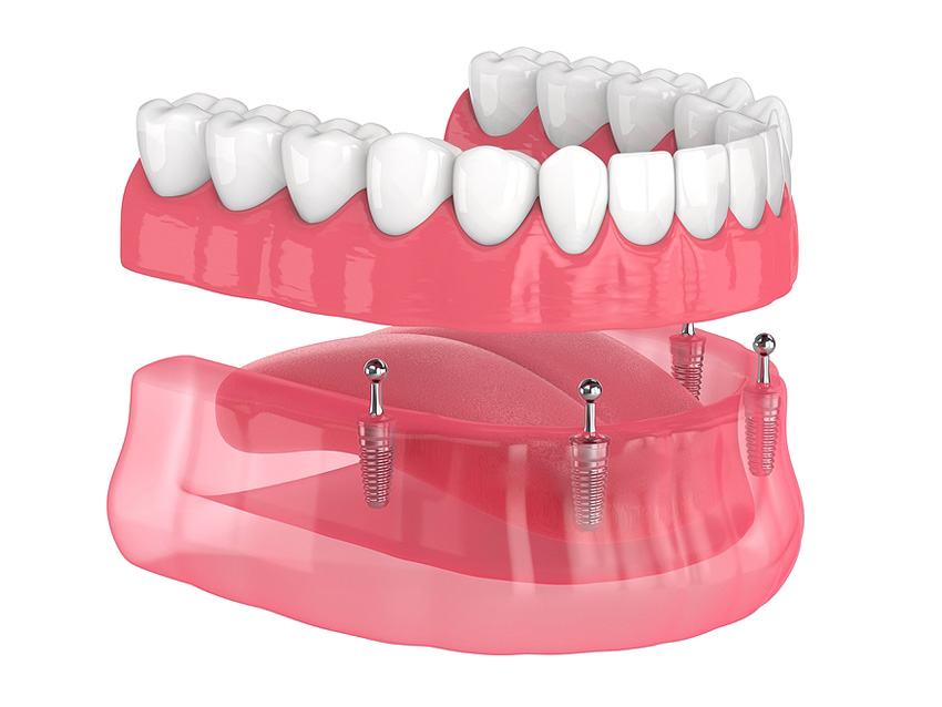 Implant1