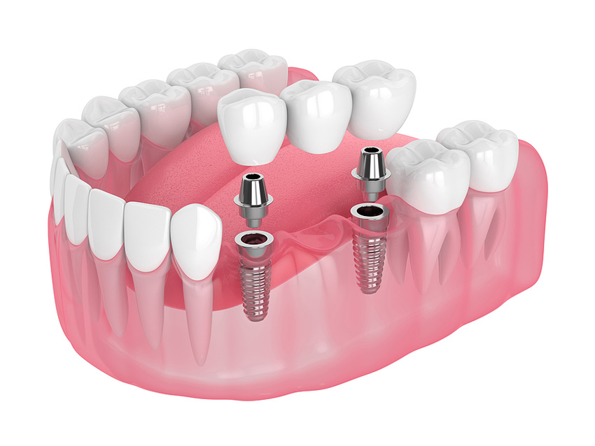 Implant4