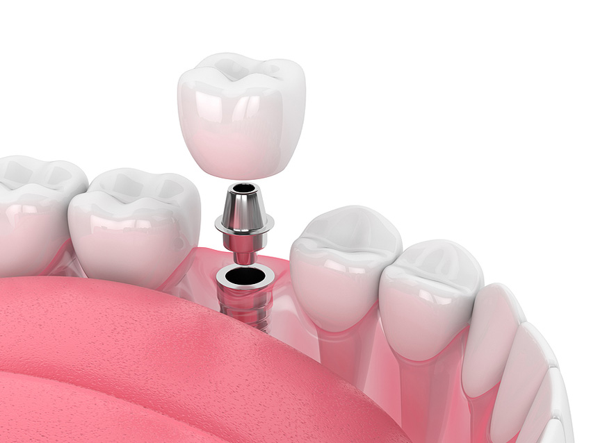 Implant6