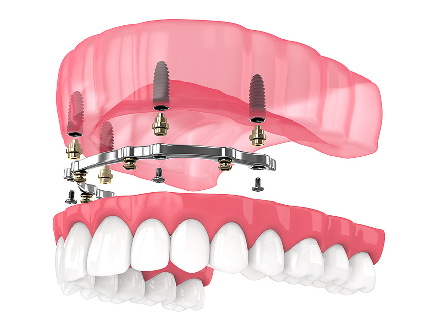 Implant7.jpg
