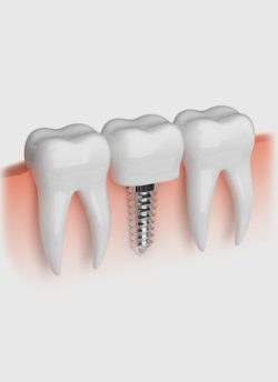 implant2